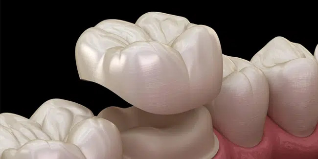 Illustration of a porcelain dental crown fitting over a prepared molar — dental crowns in Richardson, TX