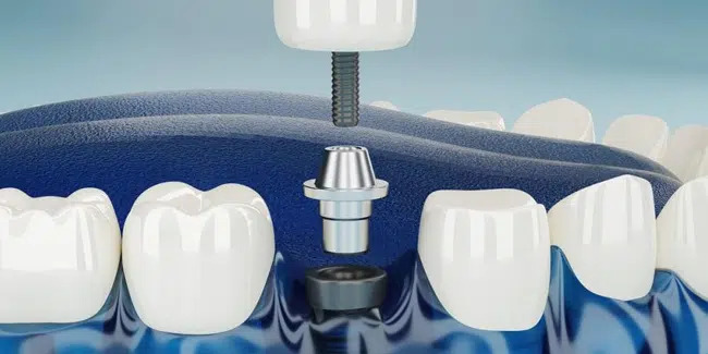Illustration of a dental implant post, abutment and crown between natural teeth — dental implants in Richardson, TX
