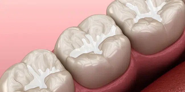 Illustration of dental sealants protecting the grooves of back molars — dental sealants in Richardson, TX
