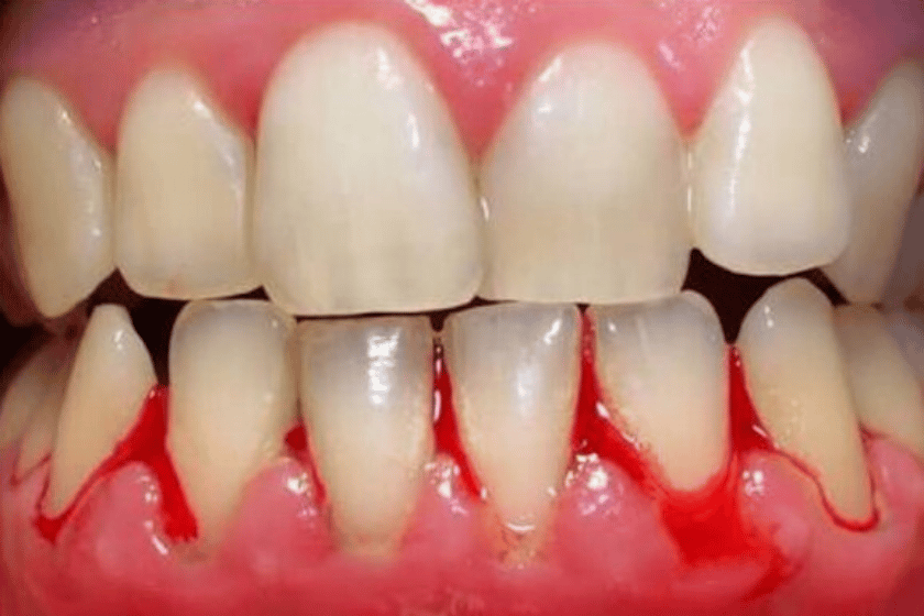 gum disease signs