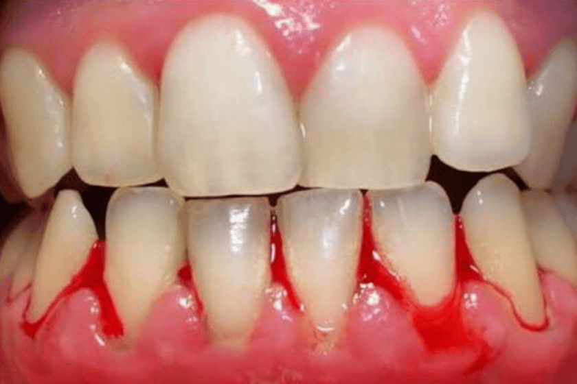 Gum Disease: Know The Signs And Symptoms