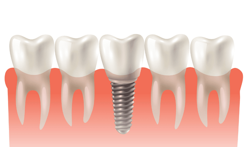 Can You Benefit From Dental Implants?