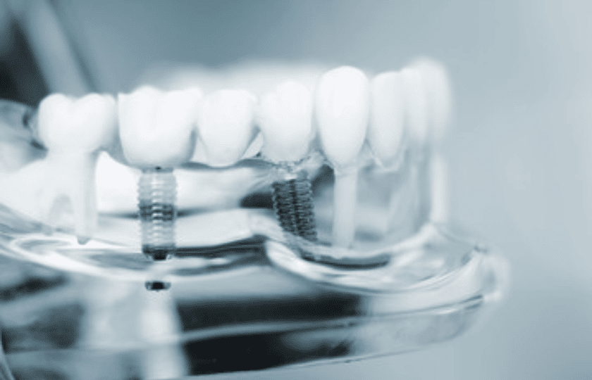 dental implants cost Richardson