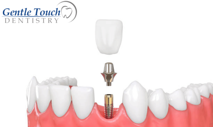 What Is Dental Plant And What Are Its Types?