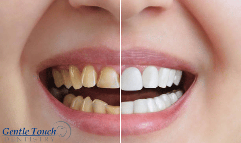 What Is The Need For Cosmetic Dentistry?