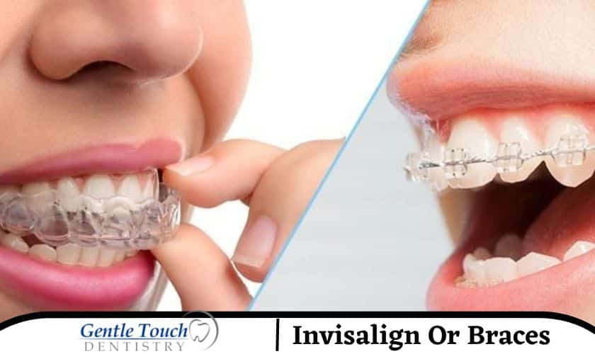 Is It Better To Get Invisalign Or Braces?