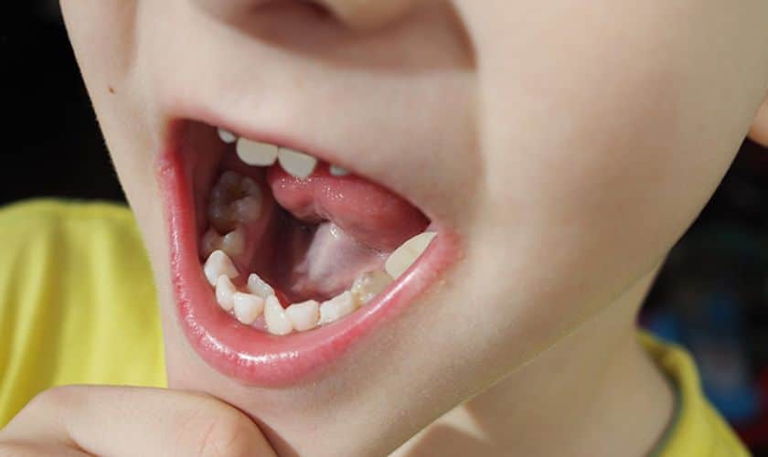 Hyperdontia And Oral Health: Know The Connection!