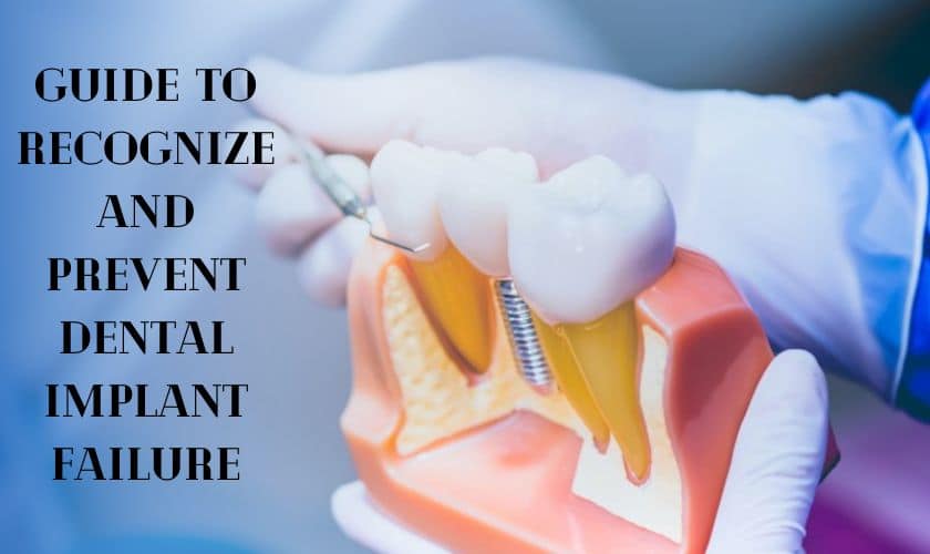 Guide to Recognize and Prevent Dental Implant Failure