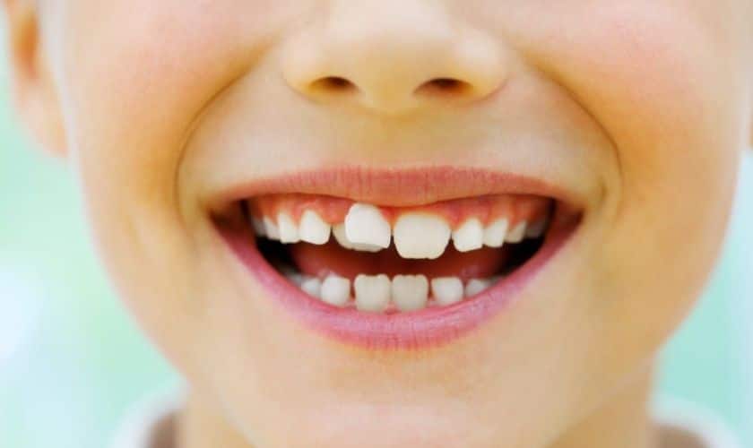 5 Ways Crooked Teeth Can Affect Your Child’s Health