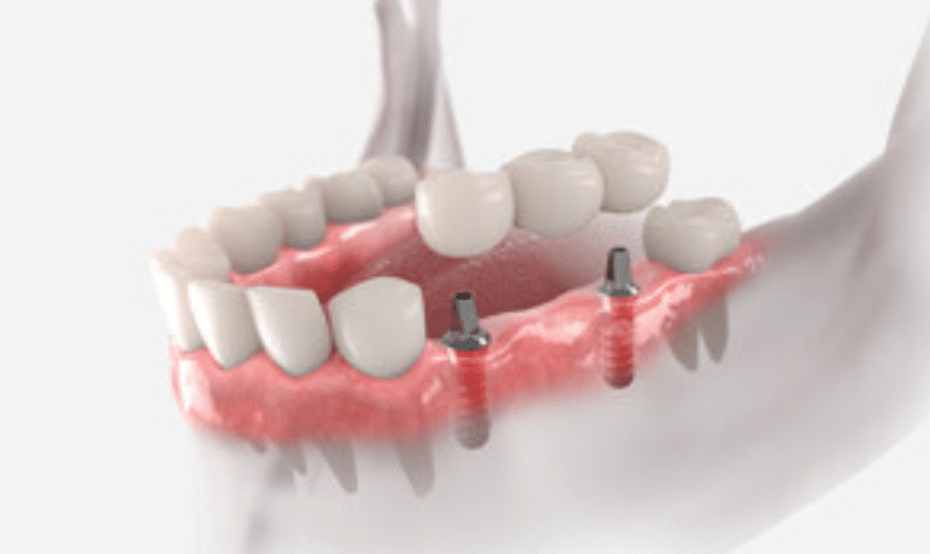 5 Immediate Actions to Take When a Dental Bridge Falls Out