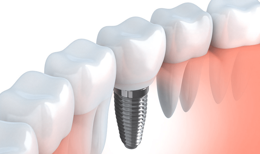 Benefits Of Advanced Dental Implants