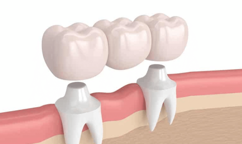 Dental Bridges Revitalize Your Radiant Smile