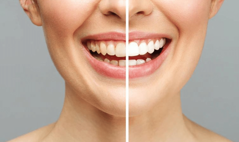 Teeth Whitening Aftercare tips