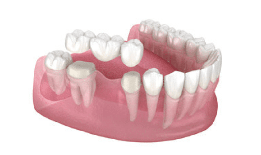 Tips For Proper Dental Bridge Aftercare