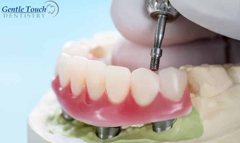 Dental Implant Recovery in Richardson, TX, Gentle Touch Dentistry Of Richardson