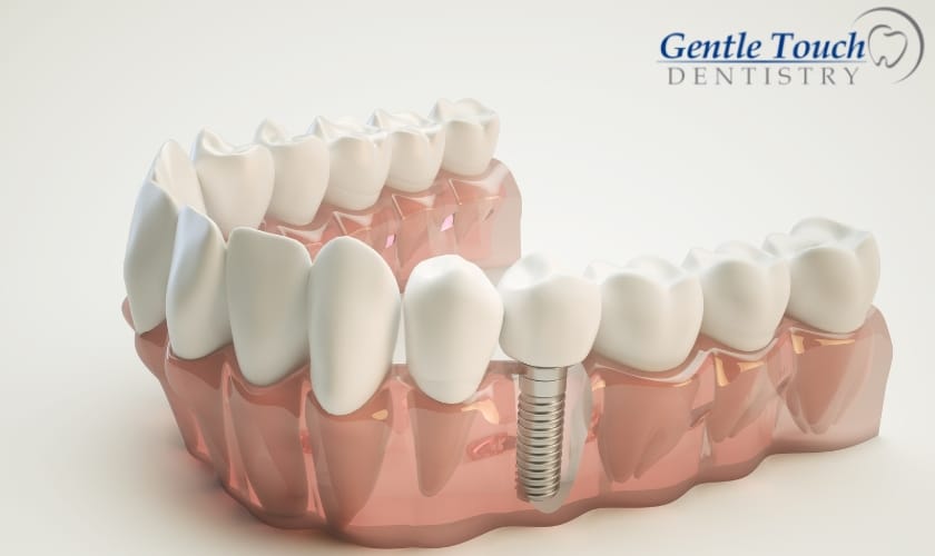 Dental Implants in Richardson, TX, Gentle Touch Dentistry Of Richardson
