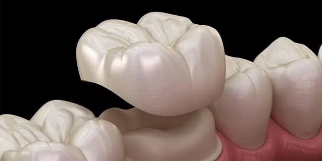 Dental Crowns in Richardson, TX, Gentle Touch Dentistry Richardson