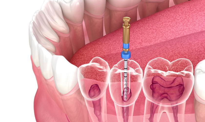 Root Canal Treatment in Richardson, TX, Gentle Touch Dentistry Richardson