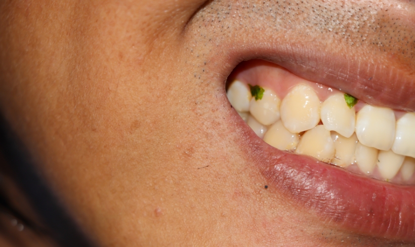 Food Trapped Around Dental Implant