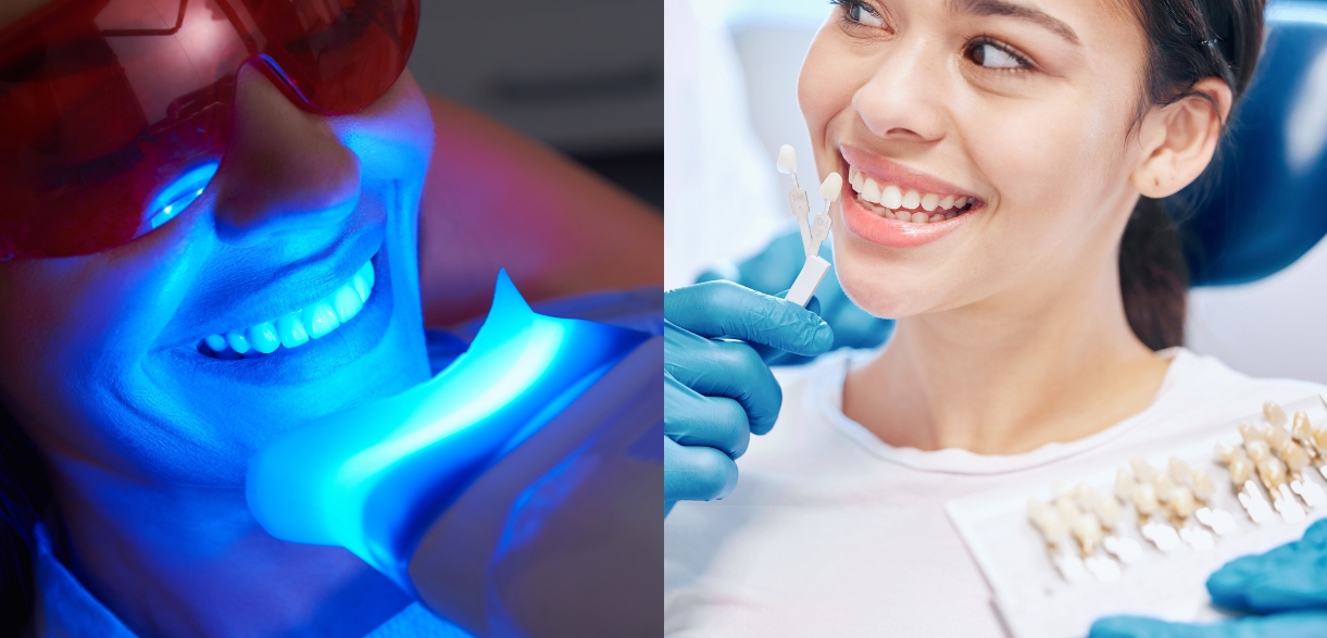 teeth whitening or veneers the best choice for stained teeth