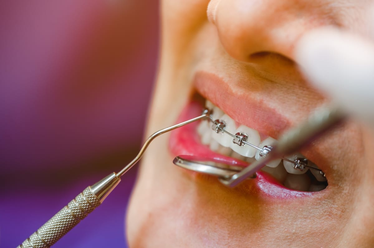 Dental Bridges in Richardson